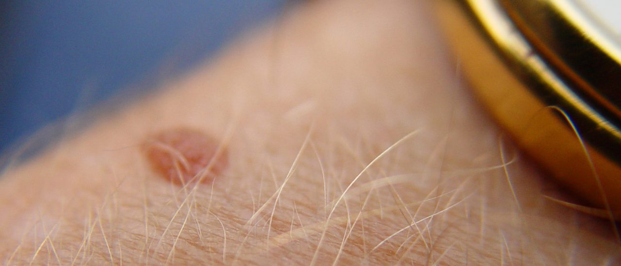 Ist dieser Leberfleck auffällig oder doch eher harmlos? Die App SkinVision soll das laut ihren Entwicklern beurteilen können. Foto: What Time Is It?. CC BY 2.0 | Scott Robinson / flickr.com