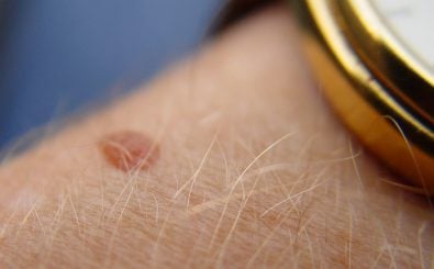 Ist dieser Leberfleck auffällig oder doch eher harmlos? Die App SkinVision soll das laut ihren Entwicklern beurteilen können. Foto: What Time Is It?. CC BY 2.0 | Scott Robinson / flickr.com