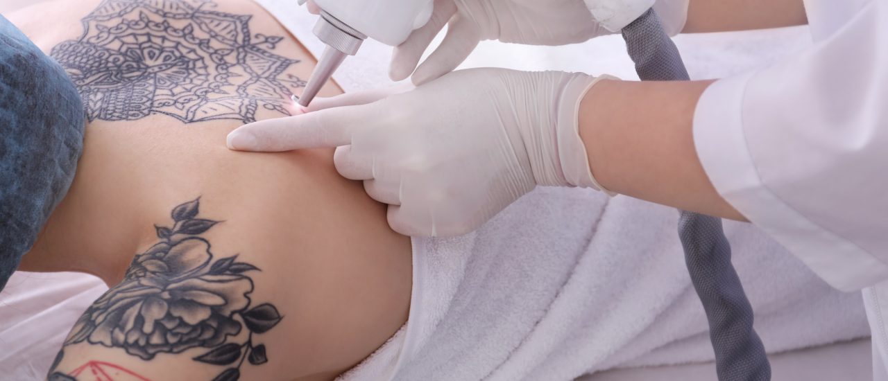 Tattoo-Entfernung birken Risiken – und manchmal auch Schmerzen. Foto: Africa Studio | shutterstock.com